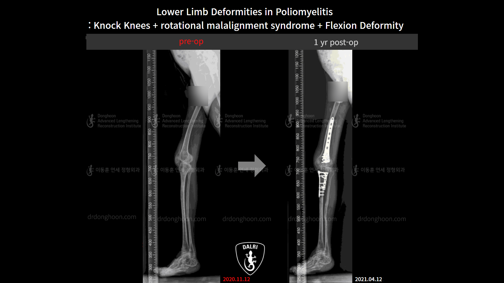 Before and after complex deformity, case 9154937, image 7, Dr. Donghoon institute (DALRI)