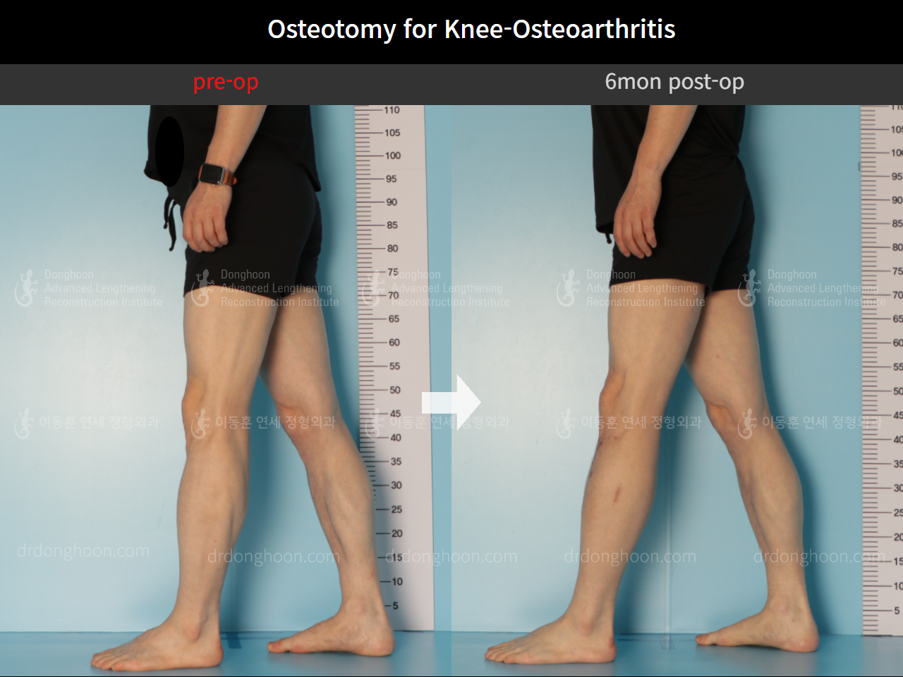 Before and after osteotomy for knee osteoarthritis, case 8796980, image 6, Dr. Donghoon institute (DALRI)