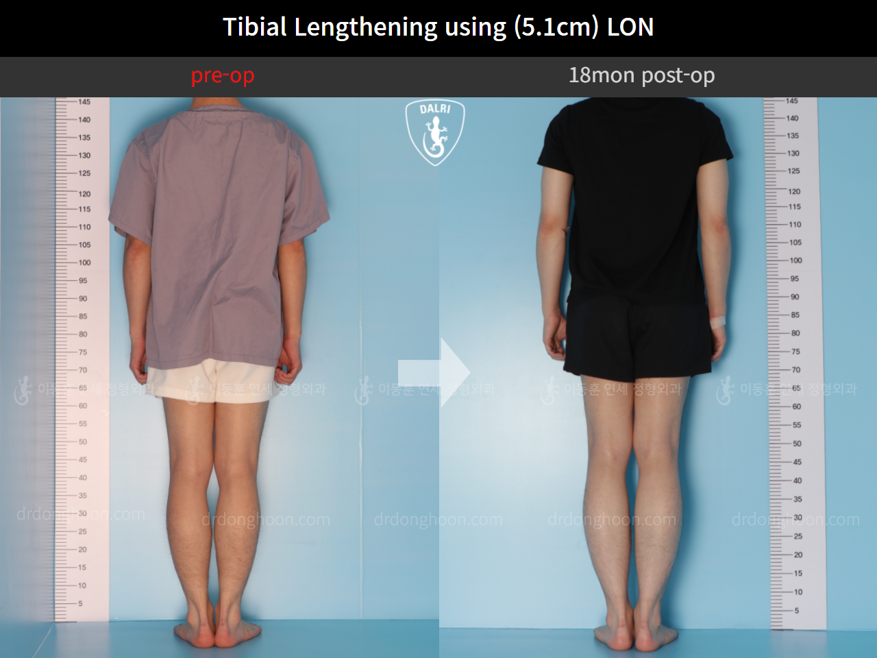 Before and after cll lon, case 9657314, image 2, Dr. Donghoon institute (DALRI)