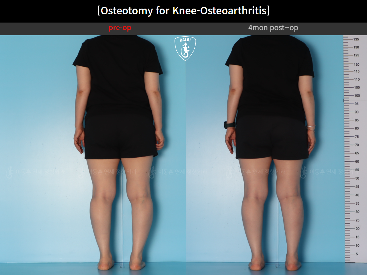 Before and after osteotomy for knee osteoarthritis, case 39778471, image 5, Dr. Donghoon institute (DALRI)