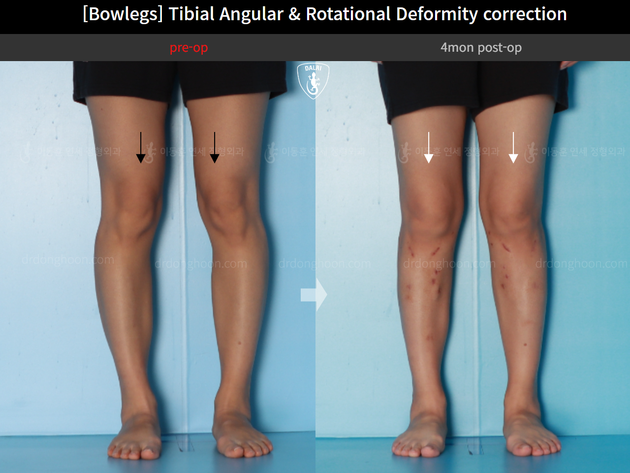 Before and after adult bowlegs, case 16530390, image 7, Dr. Donghoon institute (DALRI)