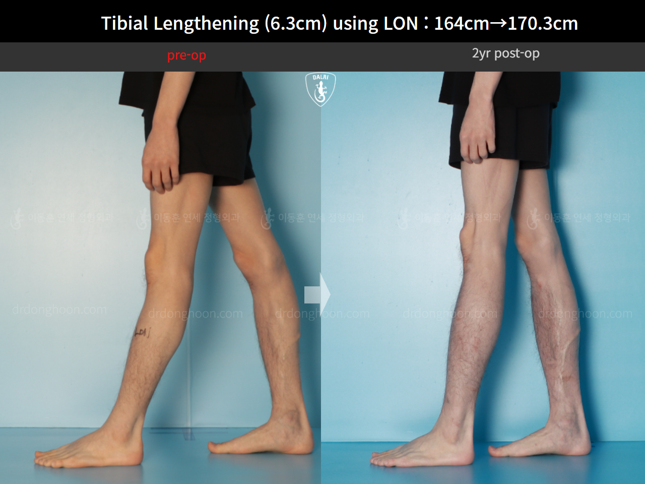 Before and after cll lon, case 16723608, image 12, Dr. Donghoon institute (DALRI)