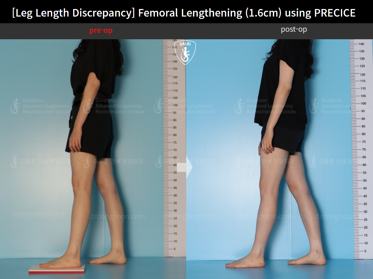 Before and after adult lld, case 15705968, image 3, Dr. Donghoon institute (DALRI)