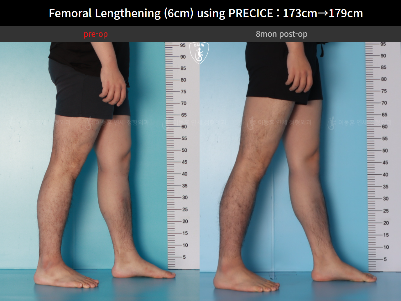 Before and after cll precice, case 89066969, image 9, Dr. Donghoon institute (DALRI)