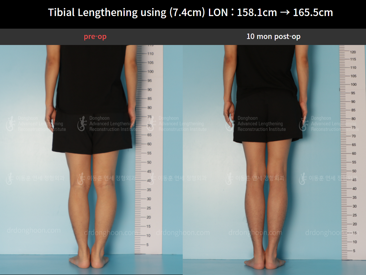 Before and after cll lon, case 8559634, image 6, Dr. Donghoon institute (DALRI)