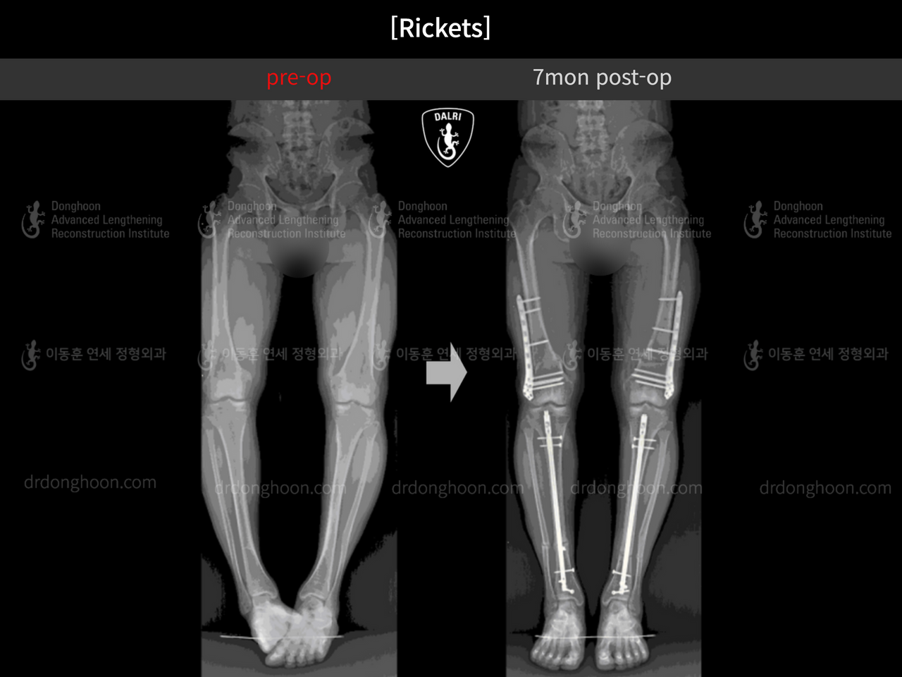 Before and after congenital condition, case 12589193, image 2, Dr. Donghoon institute (DALRI)