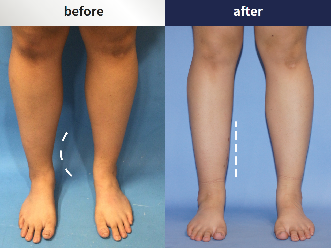 Before and after foot & ankle deformity, case 4247987, image 2, Dr. Donghoon institute (DALRI)