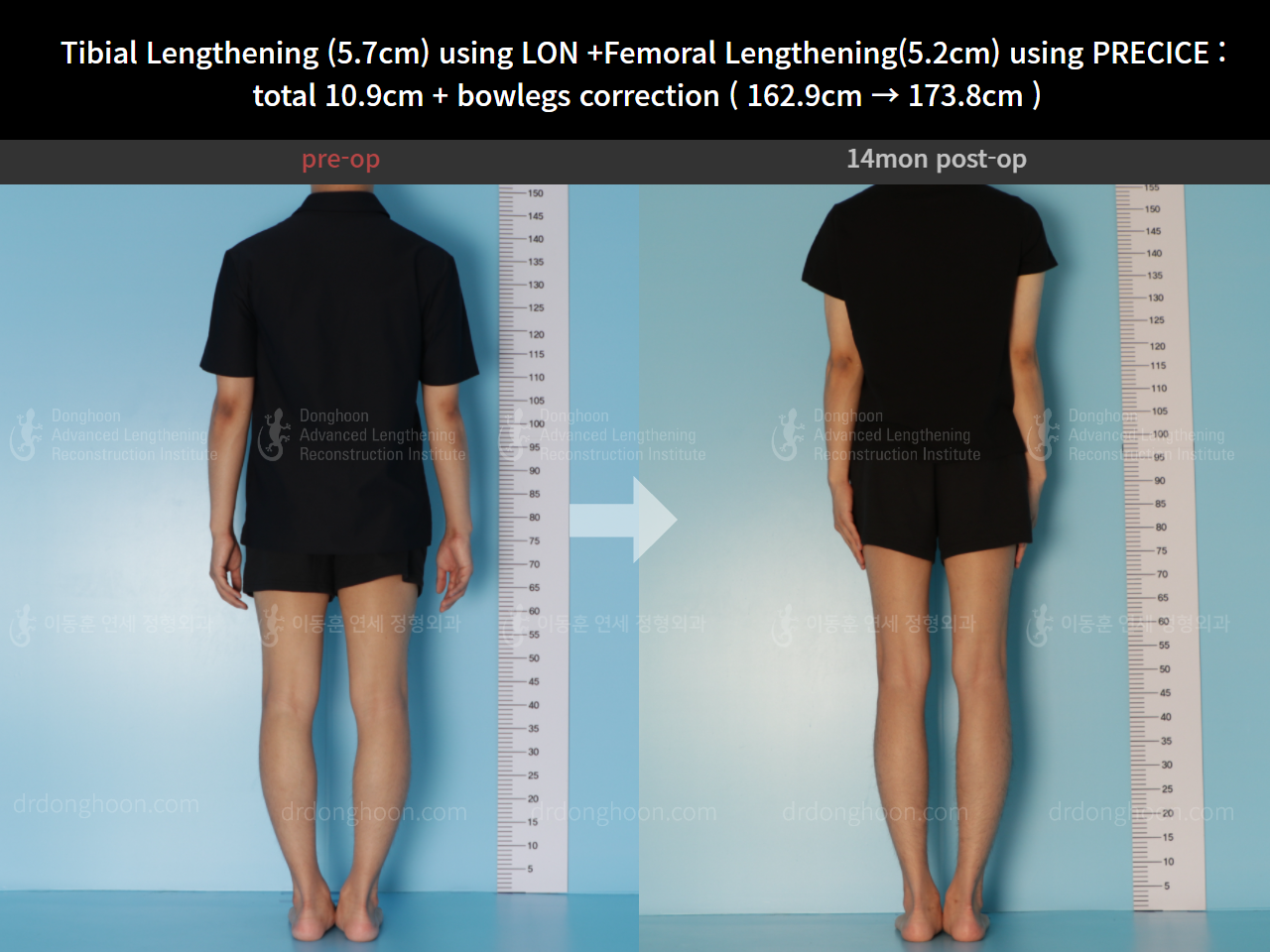 Before and after cll + deformity correction, case 8417894, image 6, Dr. Donghoon institute (DALRI)