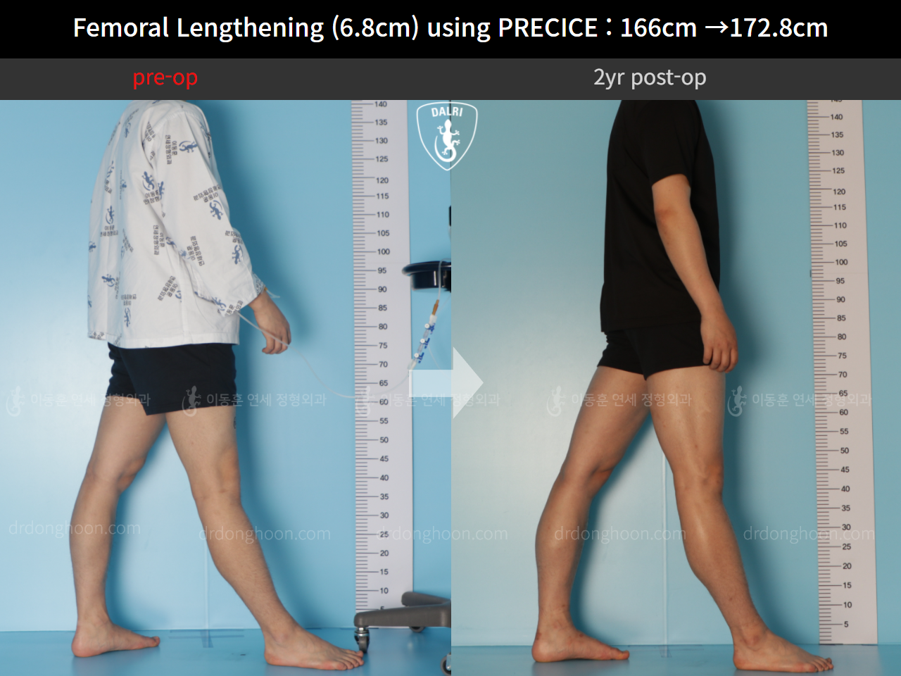 Before and after cll precice, case 10883099, image 4, Dr. Donghoon institute (DALRI)