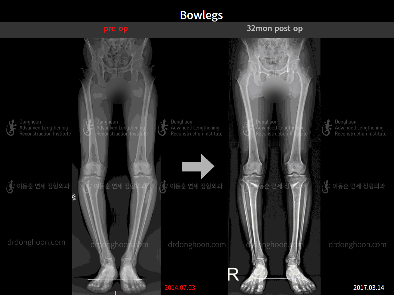 Before and after adult bowlegs, case 8838392, image 1, Dr. Donghoon institute (DALRI)