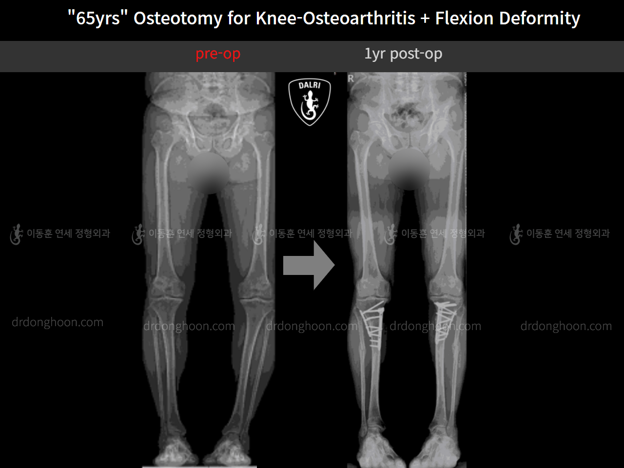 Before and after osteotomy for knee osteoarthritis, case 10742820, image 7, Dr. Donghoon institute (DALRI)
