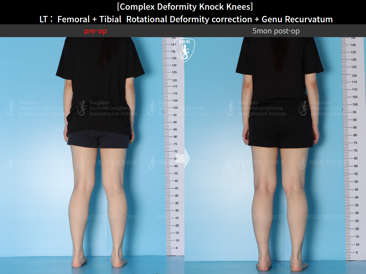 Before and after adult knock knees, case 16212764, image 4, Dr. Donghoon institute (DALRI)