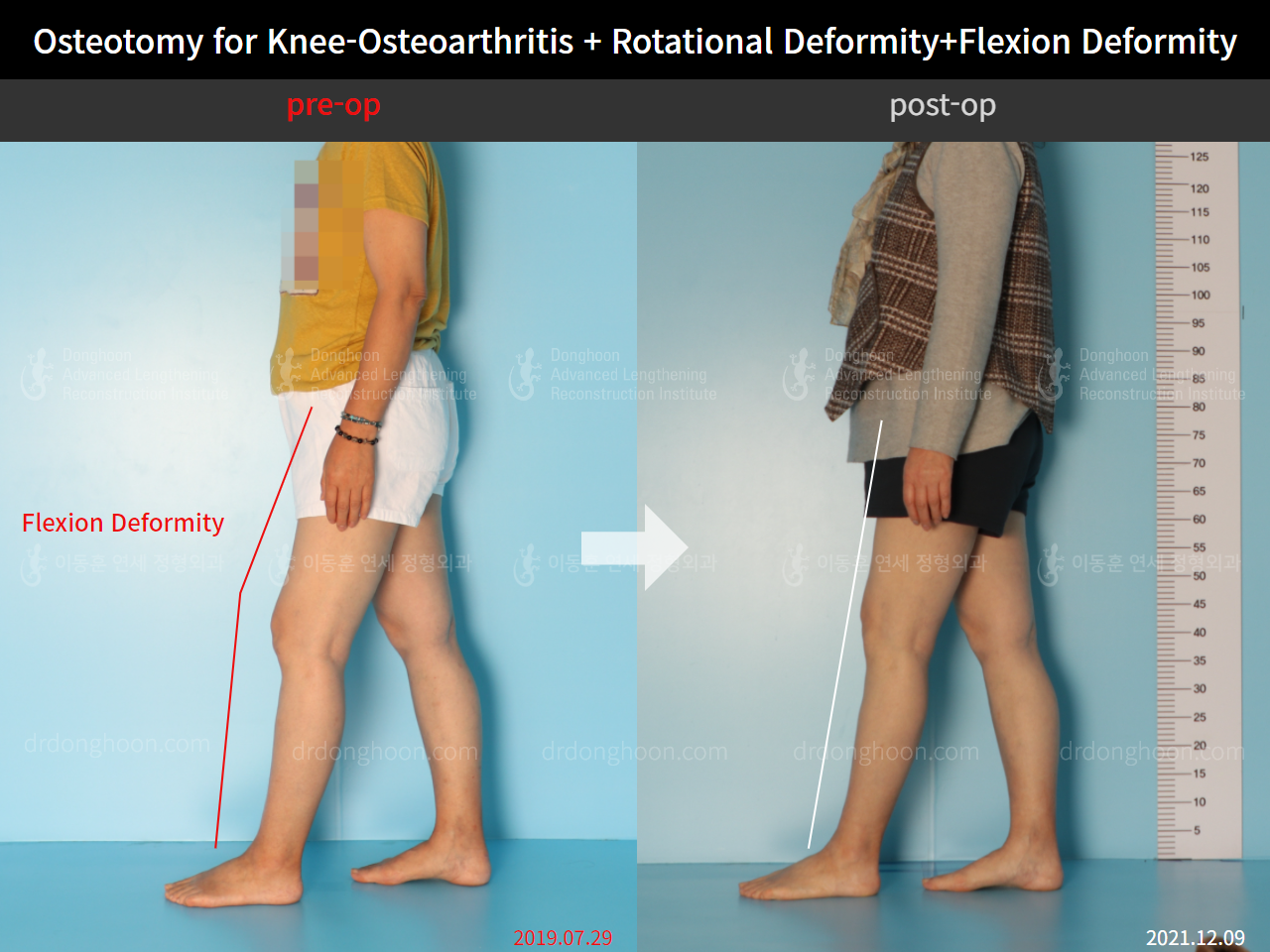 Before and after osteotomy for knee osteoarthritis, case 5987662, image 3, Dr. Donghoon institute (DALRI)