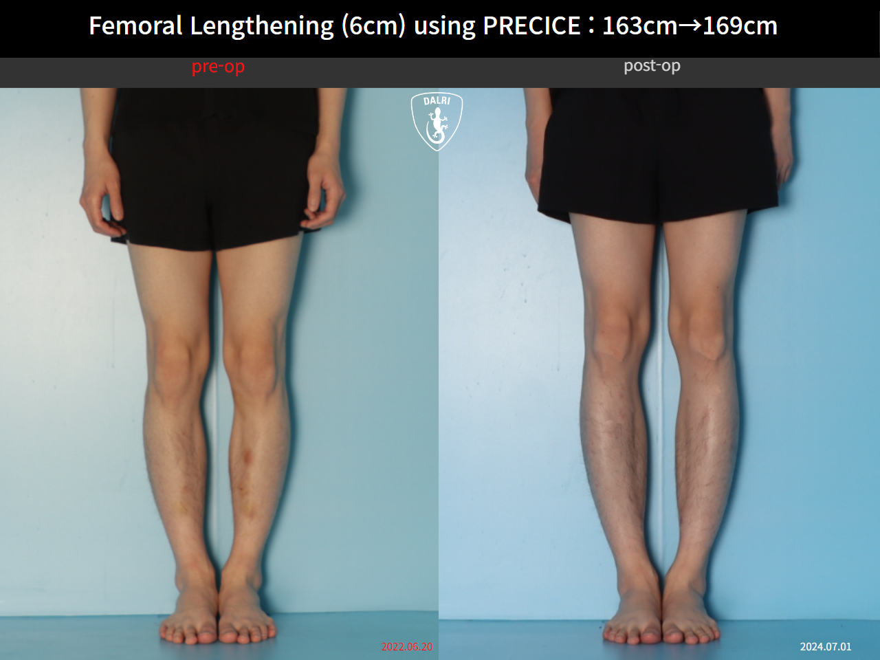 Before and after cll precice, case 33545760, image 5, Dr. Donghoon institute (DALRI)