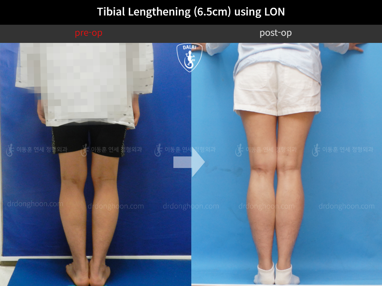 Before and after cll lon, case 4323965, image 4, Dr. Donghoon institute (DALRI)