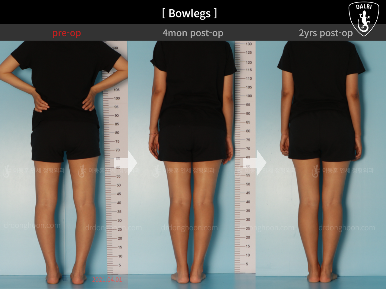 Before and after adult bowlegs, case 12060396, image 2, Dr. Donghoon institute (DALRI)