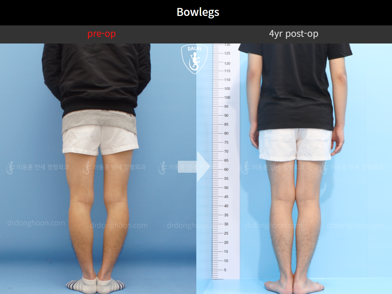 Before and after adult bowlegs, case 4311360, image 4, Dr. Donghoon institute (DALRI)