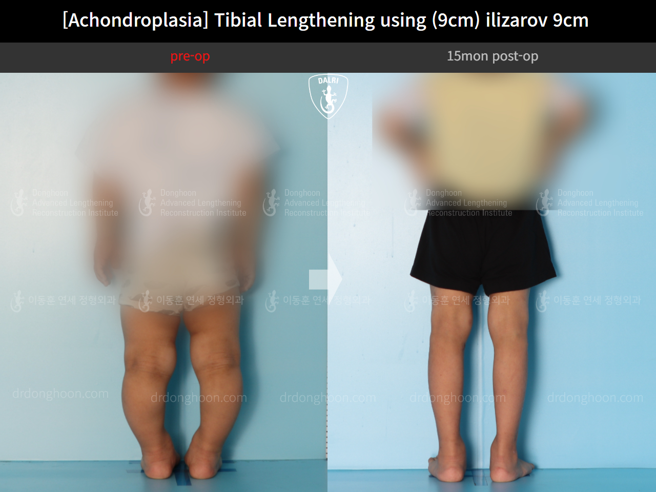 Before and after paediatric congenital condition, case 14542054, image 2, Dr. Donghoon institute (DALRI)