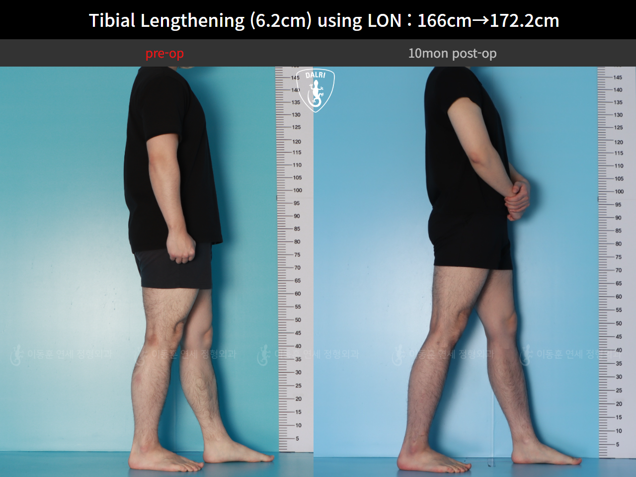Before and after cll lon, case 128591201, image 8, Dr. Donghoon institute (DALRI)