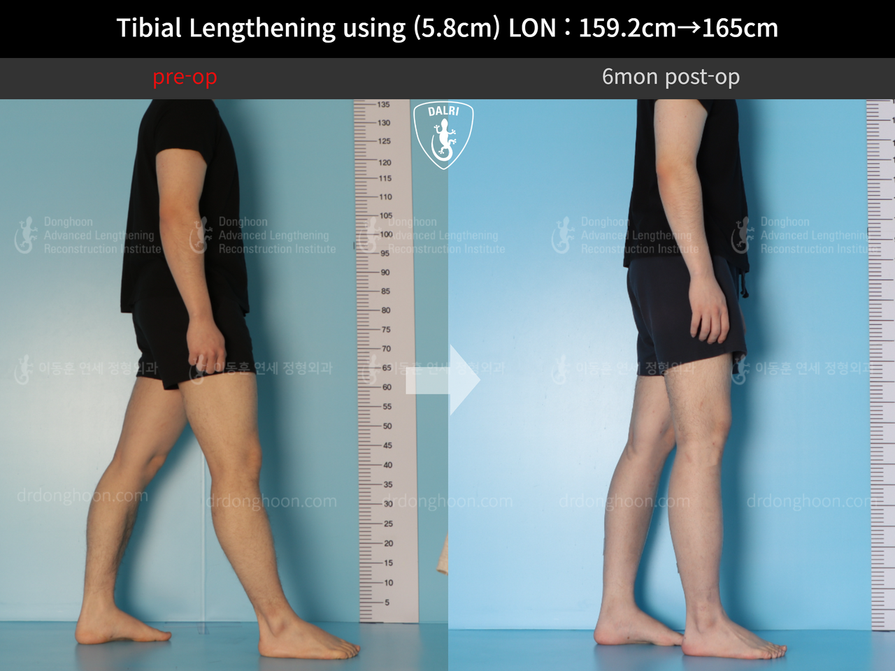 Before and after cll lon, case 12791053, image 4, Dr. Donghoon institute (DALRI)