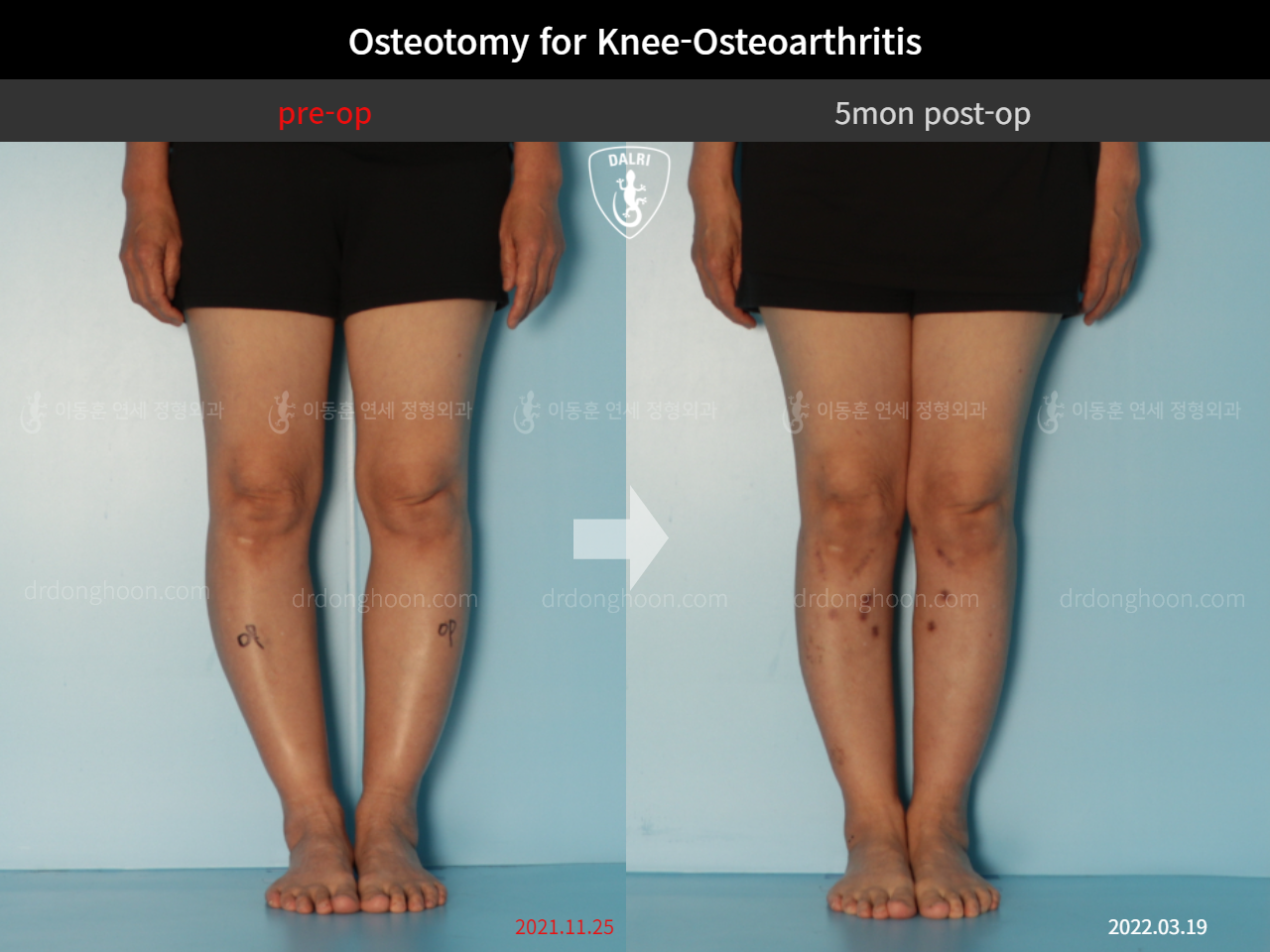 Before and after osteotomy for knee osteoarthritis, case 11047064, image 5, Dr. Donghoon institute (DALRI)