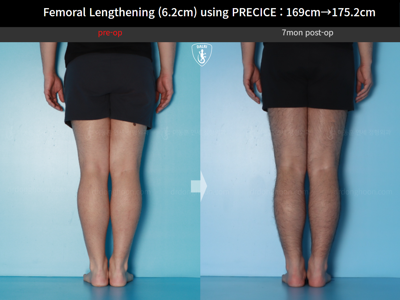Before and after cll precice, case 20671201, image 8, Dr. Donghoon institute (DALRI)