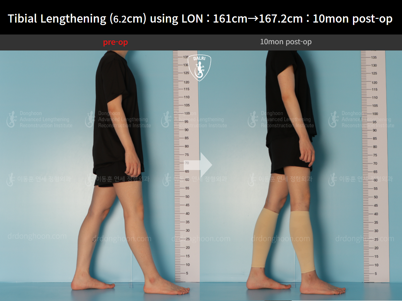 Before and after cll lon, case 14502141, image 3, Dr. Donghoon institute (DALRI)