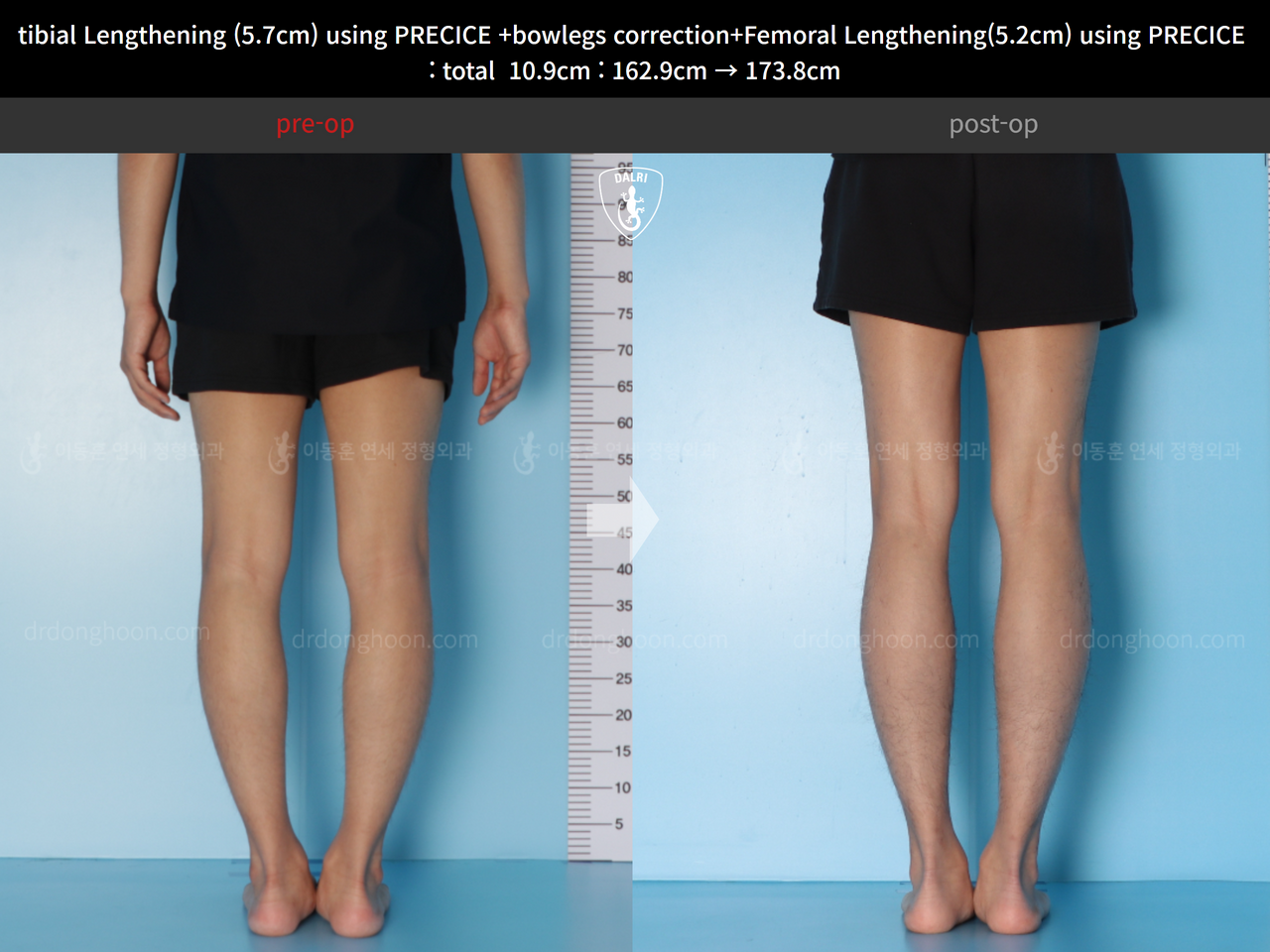 Before and after cll precice, case 13924906, image 6, Dr. Donghoon institute (DALRI)