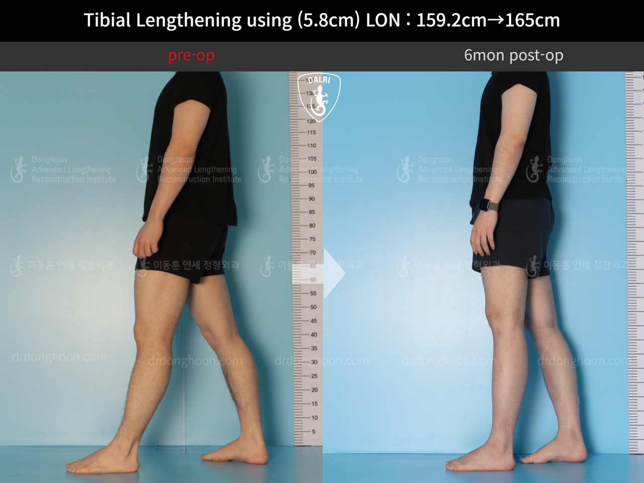 Before and after cll lon, case 12791053, image 3, Dr. Donghoon institute (DALRI)
