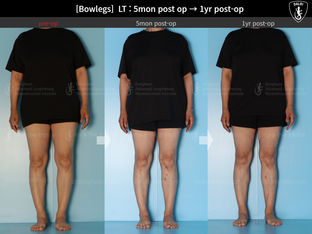 Before and after adult bowlegs, case 15172734, image 3, Dr. Donghoon institute (DALRI)