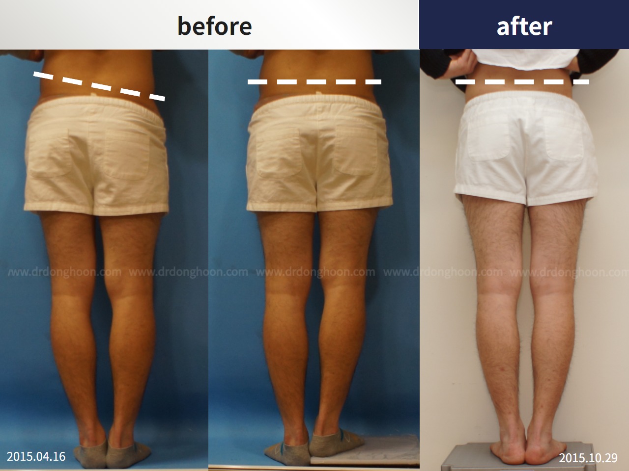 Before and after adult lld, case 4320319, image 3, Dr. Donghoon institute (DALRI)