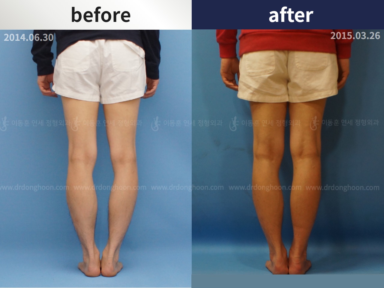 Before and after adult bowlegs, case 4311368, image 2, Dr. Donghoon institute (DALRI)