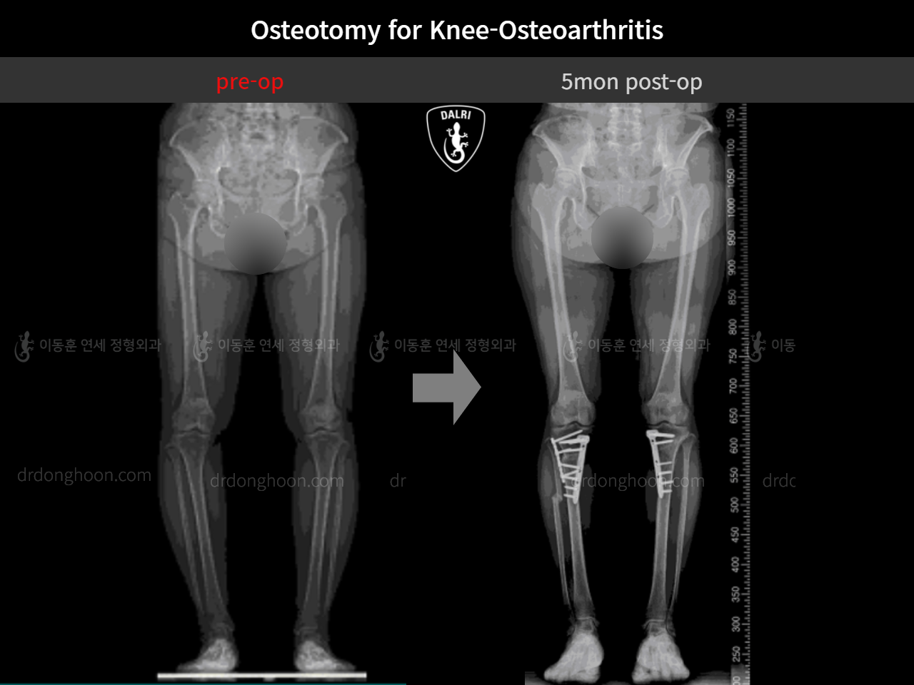 Before and after osteotomy for knee osteoarthritis, case 11047064, image 9, Dr. Donghoon institute (DALRI)