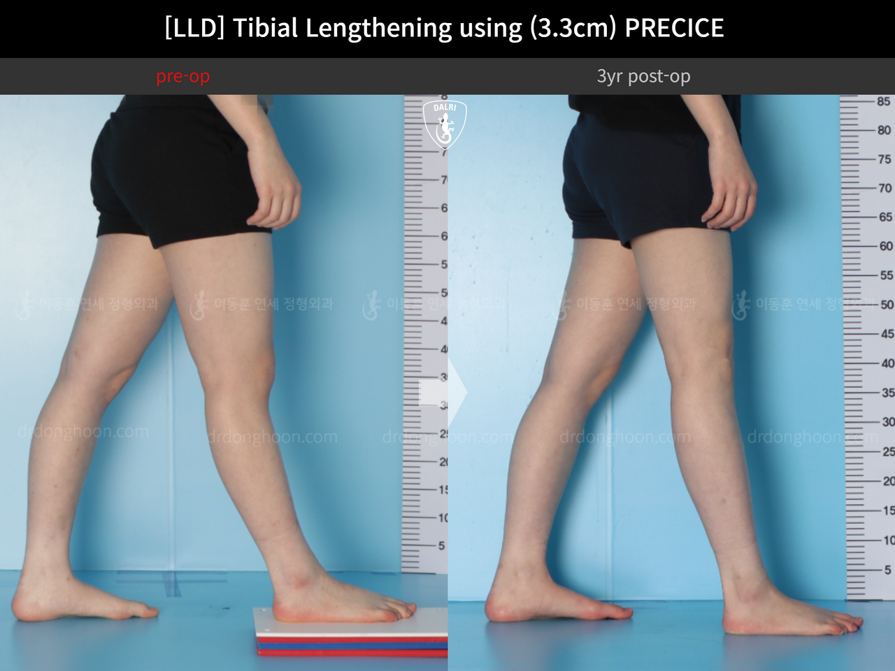 Before and after adult lld, case 14064905, image 9, Dr. Donghoon institute (DALRI)