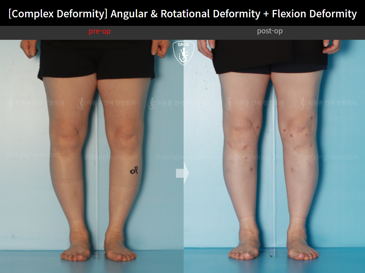 Before and after adult bowlegs, case 16781344, image 8, Dr. Donghoon institute (DALRI)