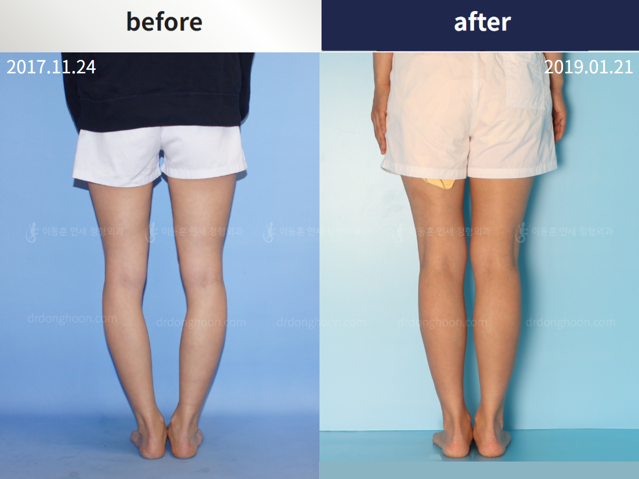 Before and after complex deformity, case 4251537, image 3, Dr. Donghoon institute (DALRI)