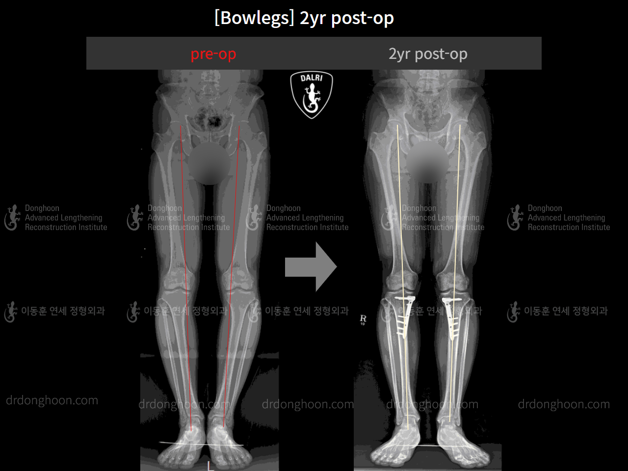Before and after adult bowlegs, case 4311027, image 6, Dr. Donghoon institute (DALRI)