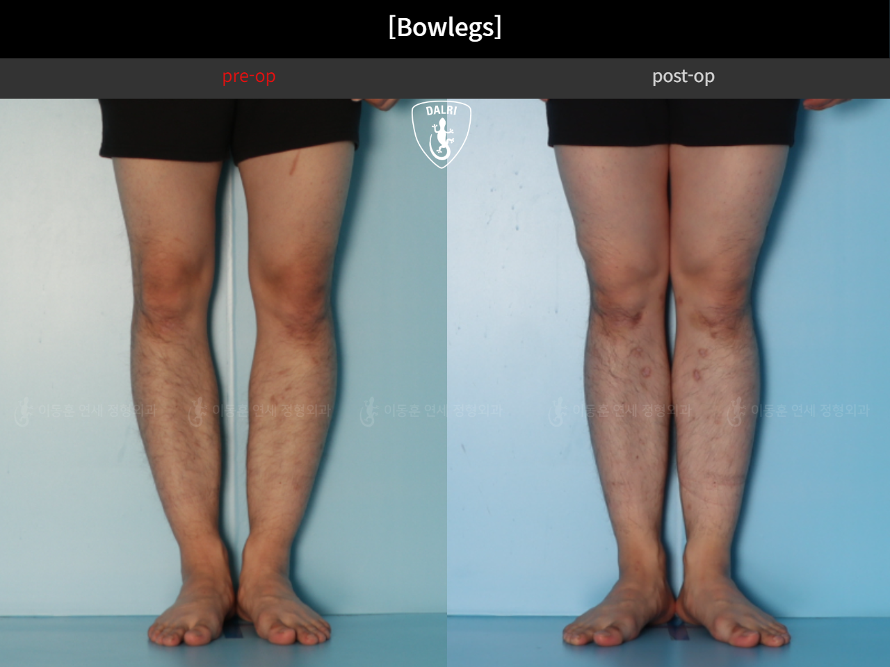 Before and after adult bowlegs, case 44111770, image 7, Dr. Donghoon institute (DALRI)