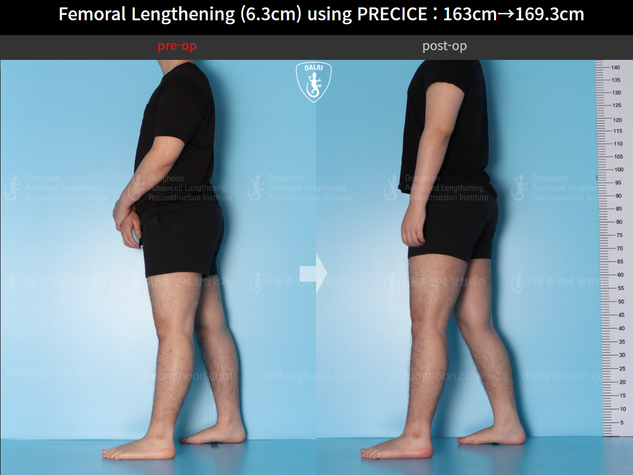 Before and after cll precice, case 15639837, image 5, Dr. Donghoon institute (DALRI)