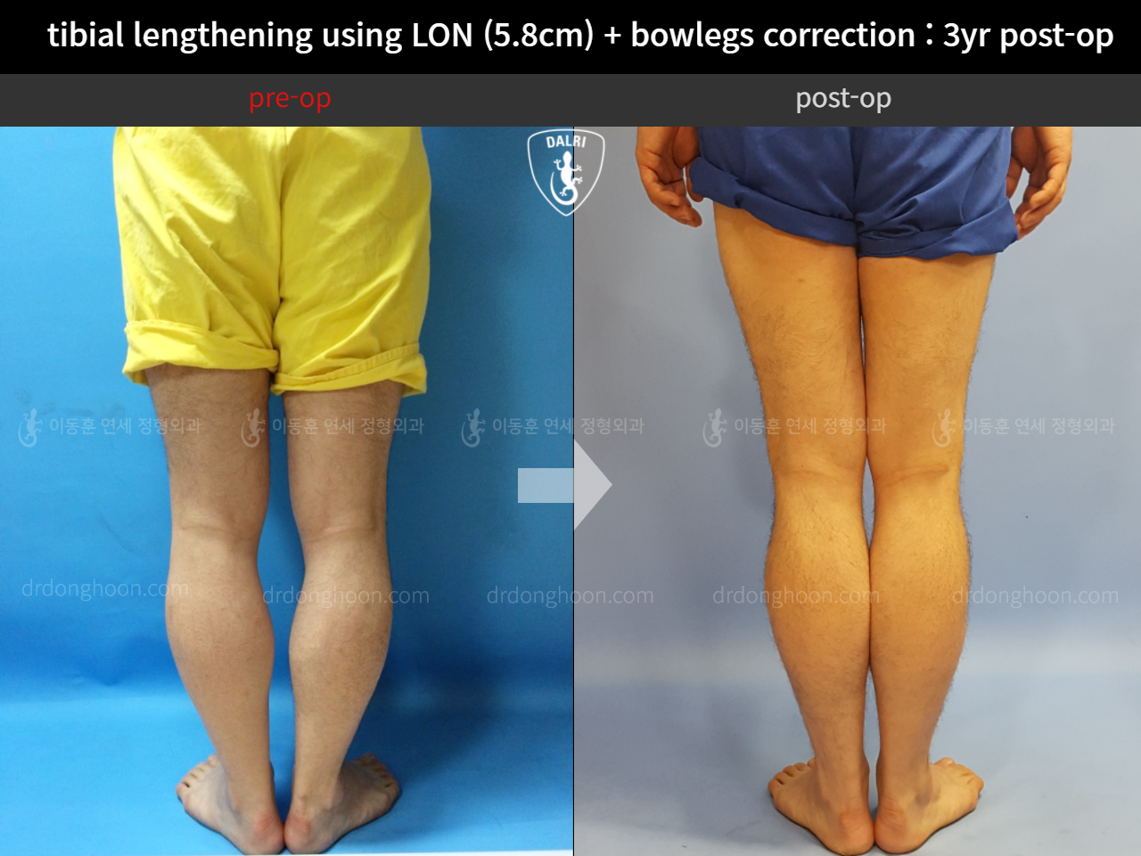 Before and after cll + deformity correction, case 11646008, image 4, Dr. Donghoon institute (DALRI)