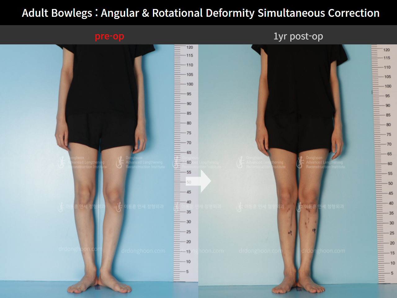 Before and after adult bowlegs, case 9058125, image 2, Dr. Donghoon institute (DALRI)