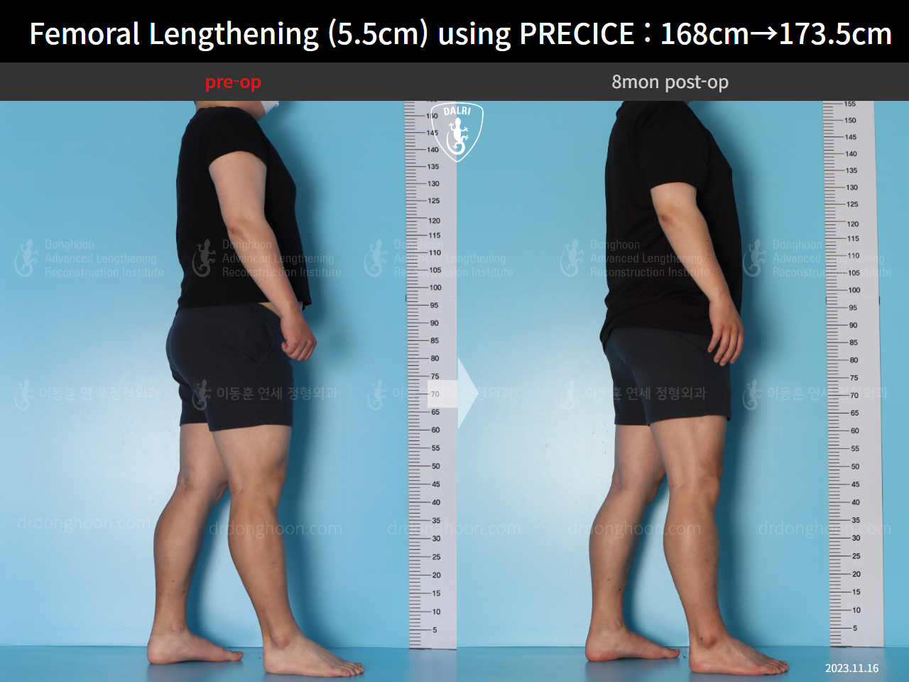 Before and after cll precice, case 16910900, image 6, Dr. Donghoon institute (DALRI)