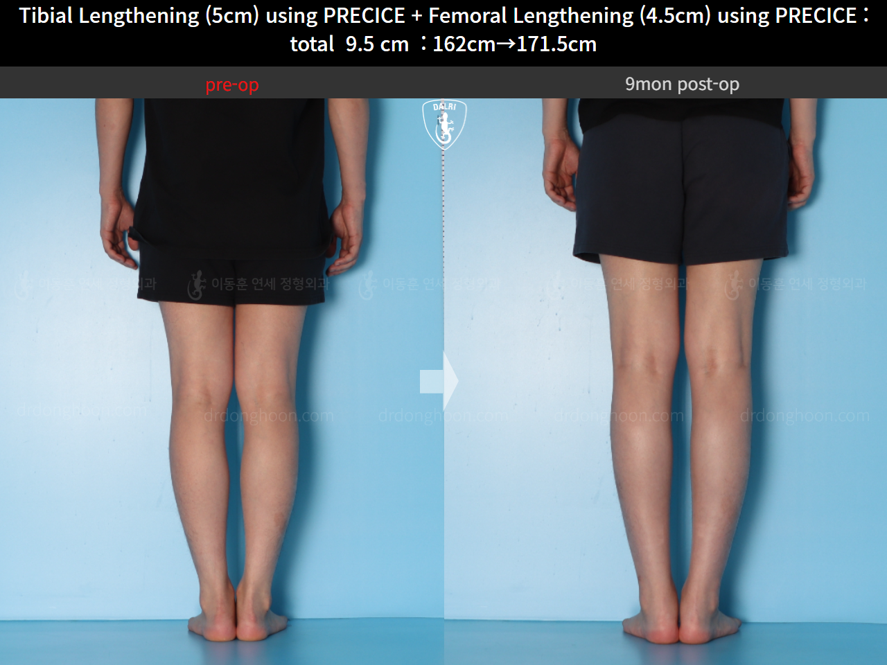 Before and after cll precice, case 15344460, image 10, Dr. Donghoon institute (DALRI)