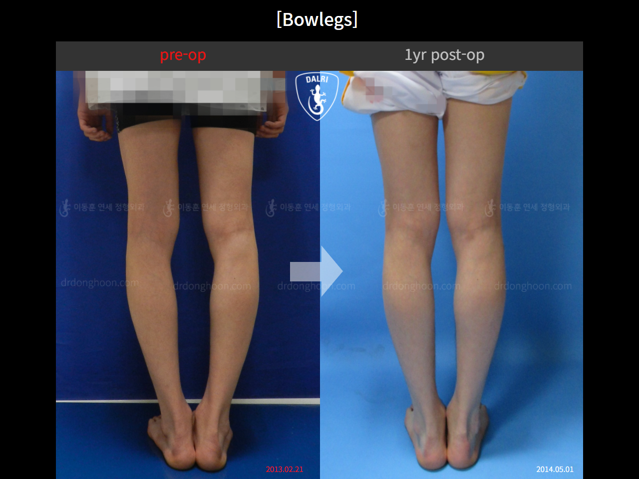 Before and after adult bowlegs, case 10571885, image 5, Dr. Donghoon institute (DALRI)