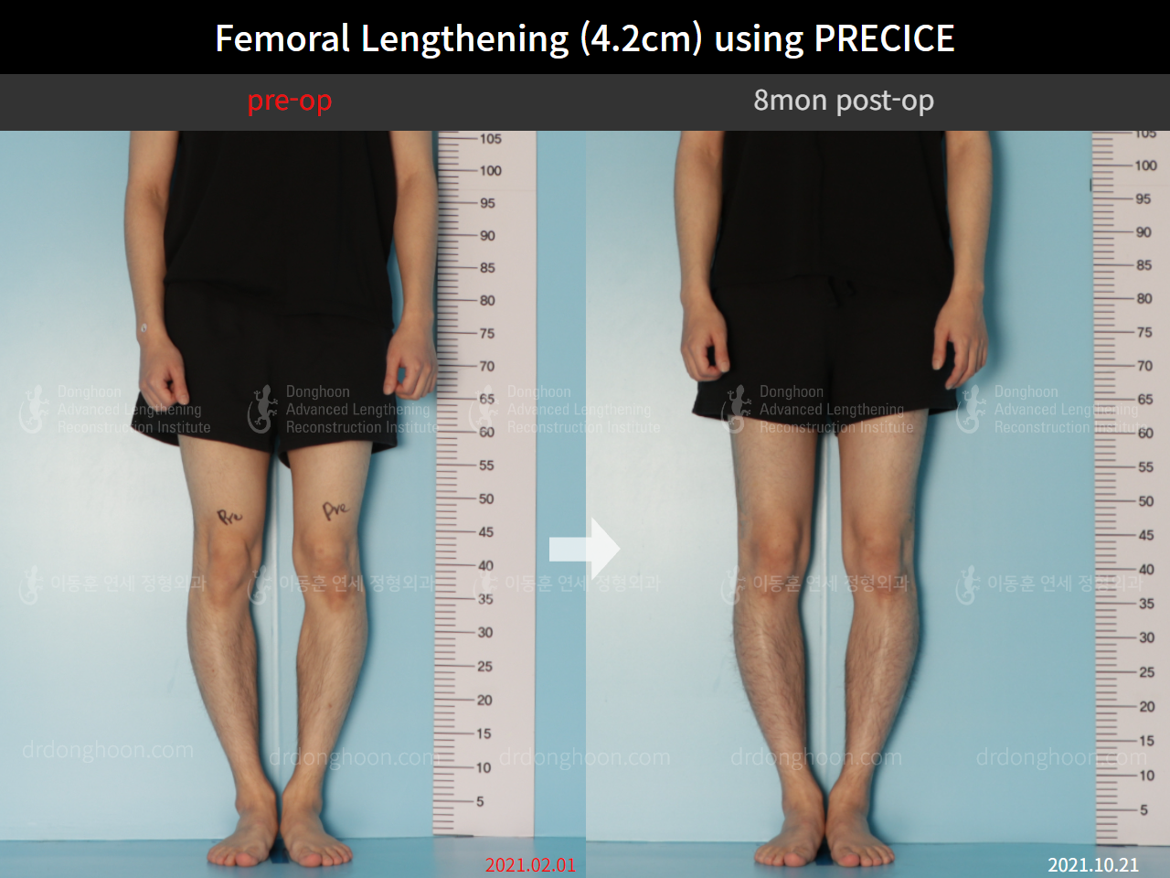 Before and after cll precice, case 8781700, image 5, Dr. Donghoon institute (DALRI)