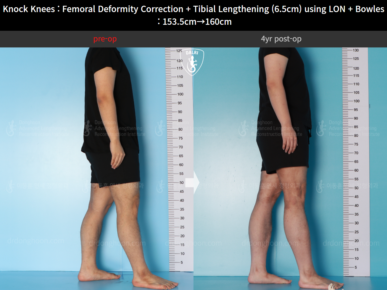 Before and after cll lon, case 16723818, image 3, Dr. Donghoon institute (DALRI)