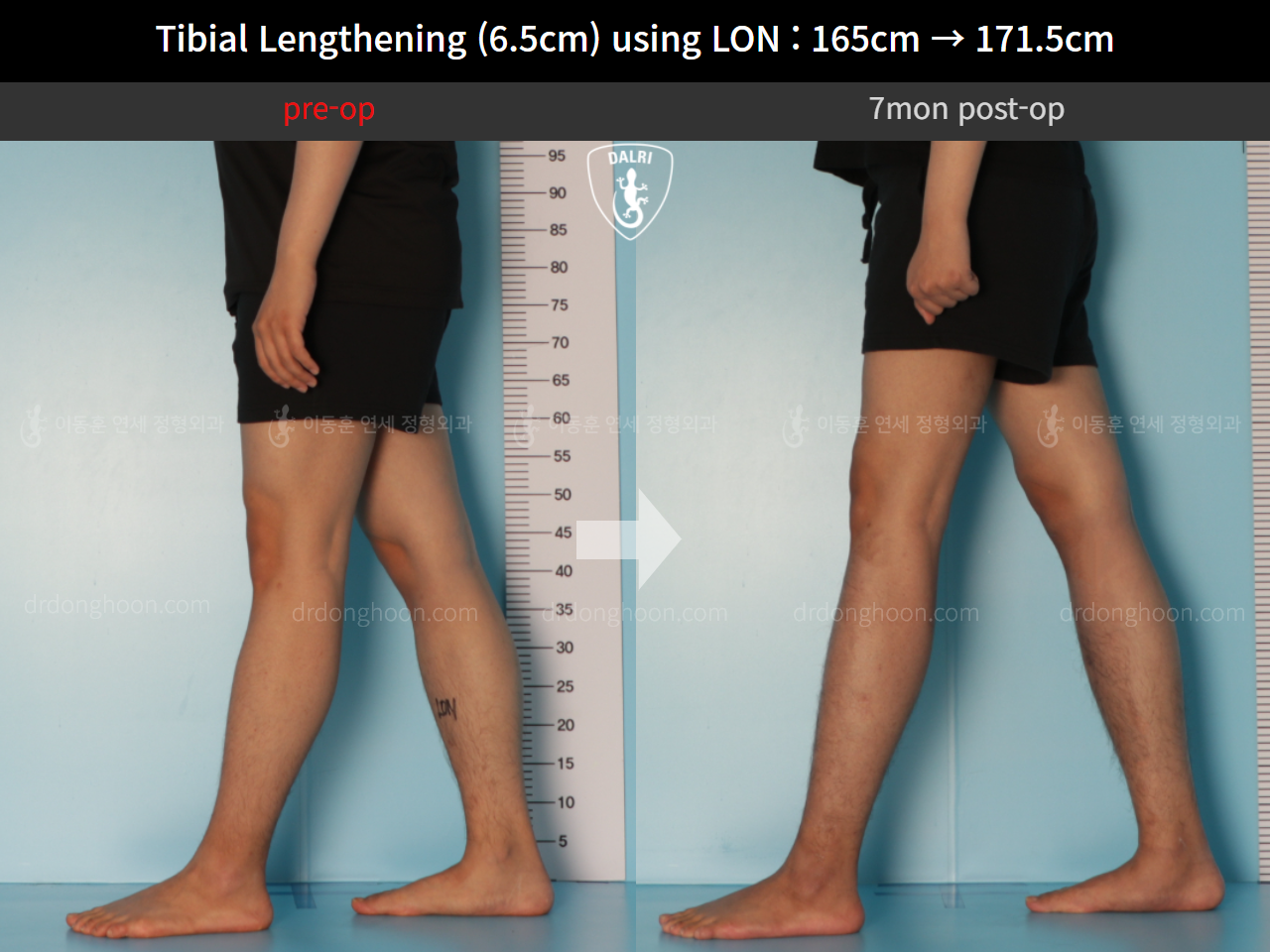 Before and after cll lon, case 10388000, image 8, Dr. Donghoon institute (DALRI)