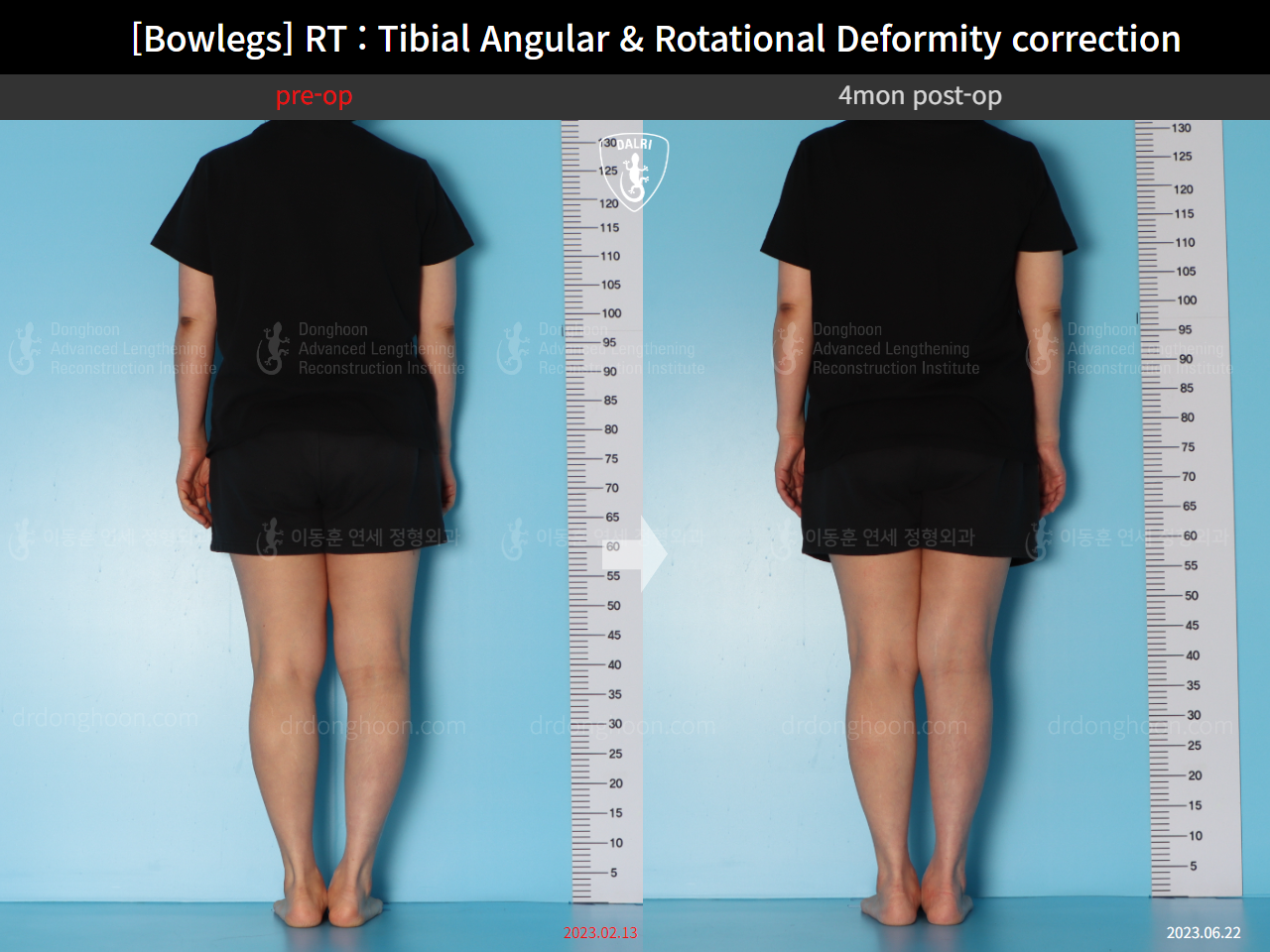 Before and after adult bowlegs, case 15741874, image 4, Dr. Donghoon institute (DALRI)