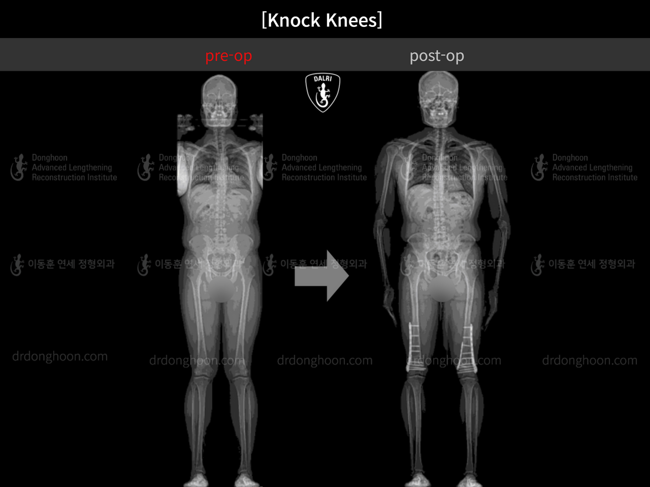 Before and after adult knock knees, case 13002083, image 1, Dr. Donghoon institute (DALRI)
