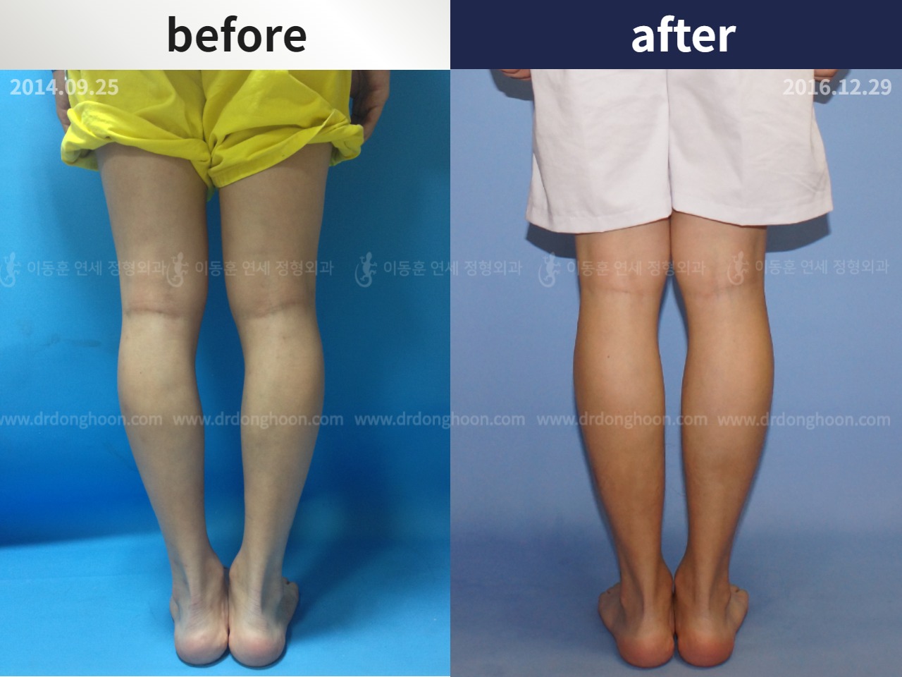 Before and after cll precice, case 4323235, image 2, Dr. Donghoon institute (DALRI)